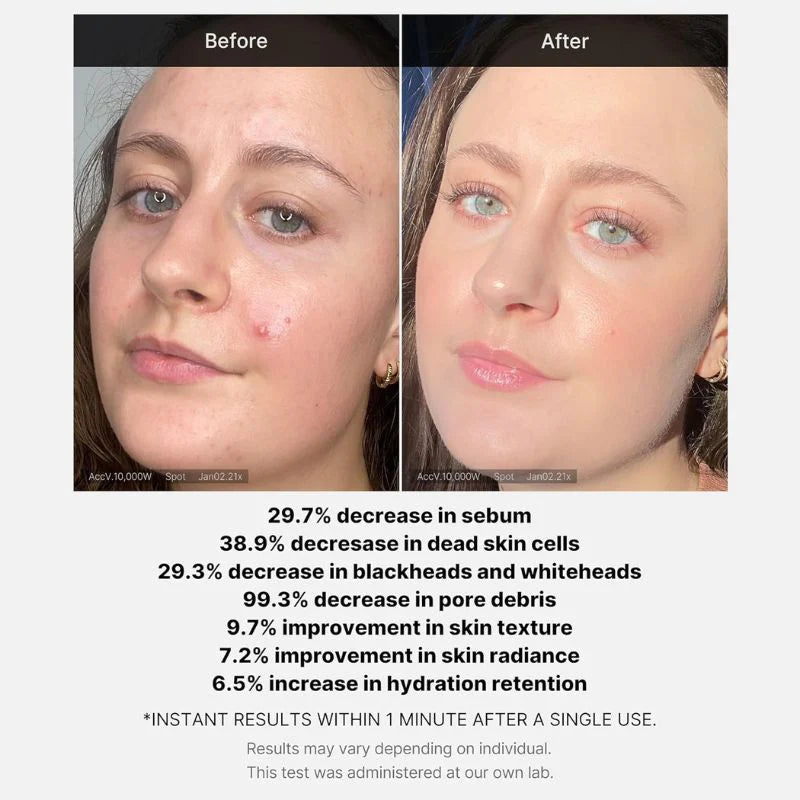 Medicube Red Acne Succinic Acid Peel